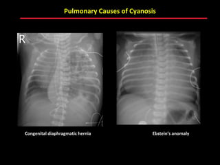 Pulmonary Causes of Cyanosis




Congenital diaphragmatic hernia             Ebstein’s anomaly




                                  ABB MD
 