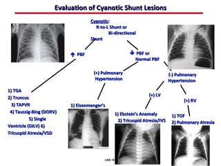 Evaluation of Cyanotic Shunt Lesions
                                   Cyanotic:
                                     R-to-L Shunt or
                                           Bi-directional
                                   Shunt


                           PBF                        PBF or
                                                       Normal PBF

                                    (+) Pulmonary                          (-) Pulmonary
                                     Hypertension                          Hypertension

1) TGA
                                                               (+) LV
2) Truncus
                                                                                  (+) RV
  3) TAPVR                1) Eisenmenger’s
 4) Taussig-Bing (DORV)                       1) Ebstein’s Anomaly          1) TOF
           5) Single                            2) Tricuspid Atresia/IVS    2) Pulmonary Atresia
Ventricle (DILV) 6)
Tricuspid Atresia/VSD




                                         ABB MD
 