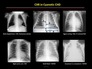 CXR in Cyanotic CHD




Boot shaped heart -TOF; Pulmonary atresia                              Egg-on-string -TGA; Tri atresia/TGA




              Right aortic arch -TOF              Small Heart -TAPVR     Snowman in a snowstorm -TAPVR
                                                  ABB MD
 