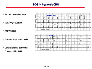 ECG in Cyanotic CHD


• d-TGA: normal or RVH                Normal EKG



• TOF, PA/VSD: RVH

• TAPVR: RVH
                                            RVH

• Truncus arteriosus: BVH

• Cardiosplenic: abnormal
  P wave, LAD, RVH




                                   ABB MD
 