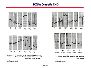 ECG in Cyanotic CHD




Pulmonary Atresia/IVS: absent RV forces,            Tricuspid Atresia: absent RV forces,
                    normal axis, atrial                                       LAD, atrial
enlargement                                         enlargement

                                           ABB MD
 