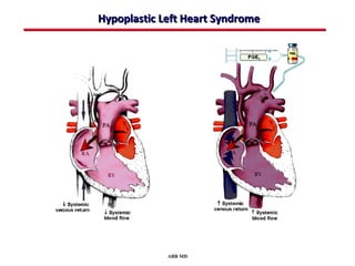 Hypoplastic Left Heart Syndrome




             ABB MD
 