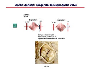 Aortic Stenosis: Congenital Bicuspid Aortic Valve




                      ABB MD
 