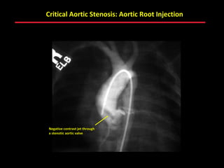 Critical Aortic Stenosis: Aortic Root Injection




Negative contrast jet through
a stenotic aortic valve




                                ABB MD
 