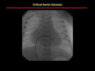 Critical Aortic Stenosis




         ABB MD
 