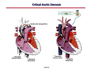 Critical Aortic Stenosis




         ABB MD
 