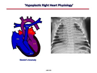 ‘Hypoplastic Right Heart Physiology’




Ebstein’s Anomaly



                    ABB MD
 