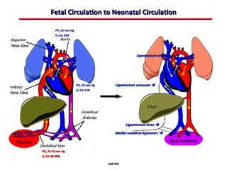 Fetal Circulation to Neonatal Circulation

         PO2 21 mm Hg
         O2 Sat 55%




                                                      Ligamentum arteriosum 




                        PO2 20 mm Hg      Ligamentum venosum 
                        O2 Sat 52%




                                                Ligamentum teres 

                                          Medial umbilical ligaments 



PO2 32-35 mm Hg
O2 Sat 82-88%

                                       ABB MD
 