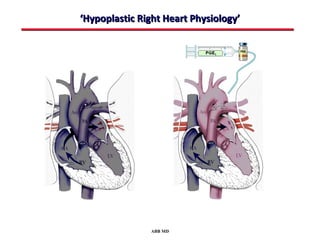 ‘Hypoplastic Right Heart Physiology’




               ABB MD
 