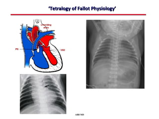 ‘Tetralogy of Fallot Physiology’




            ABB MD
 