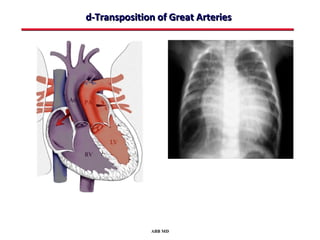 d-Transposition of Great Arteries




              ABB MD
 