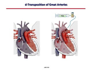 d-Transposition of Great Arteries




              ABB MD
 