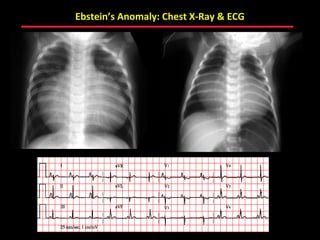 Ebstein’s Anomaly: Chest X-Ray & ECG




                ABB MD
 