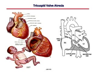 Tricuspid Valve Atresia




         ABB MD
 