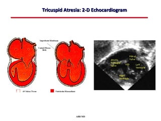 Tricuspid Atresia: 2-D Echocardiogram




              ABB MD
 