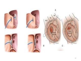 Chd surgical procedure | PPTX