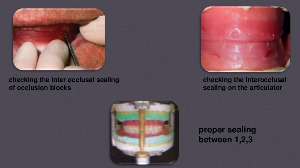 Check bite technique