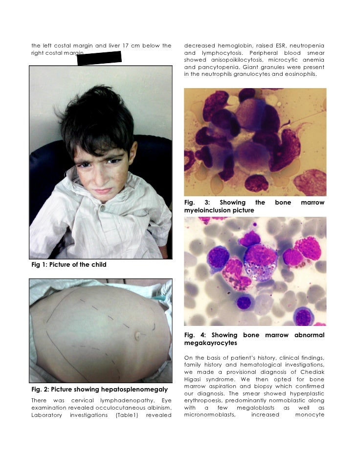 Chediak Higashi Syndrome