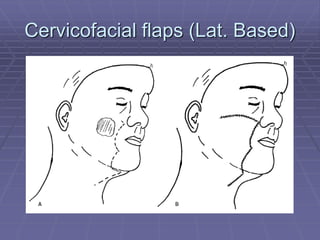 cheek-reconstruction-ppt.ppt