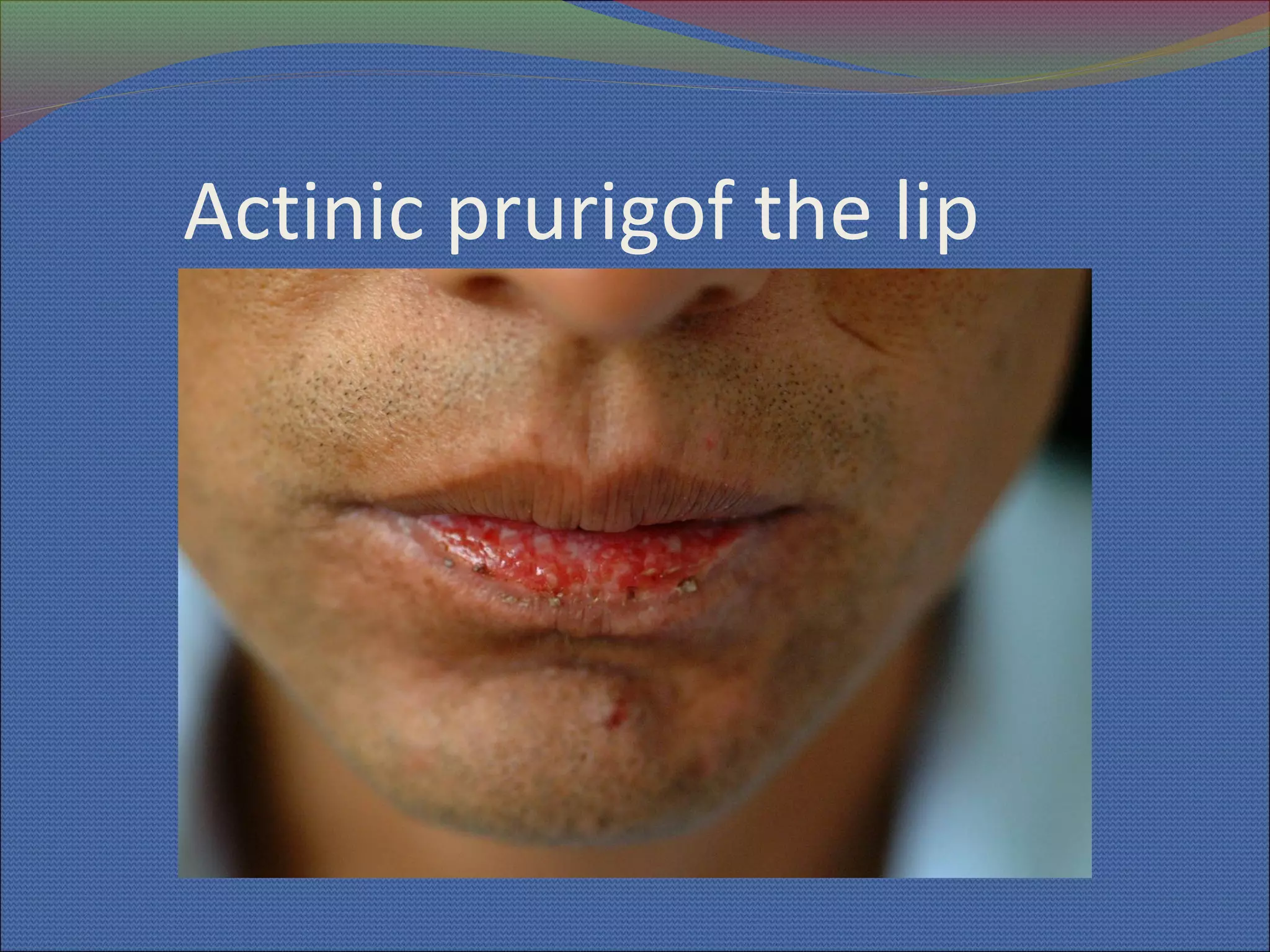 Cheilitis | PPT