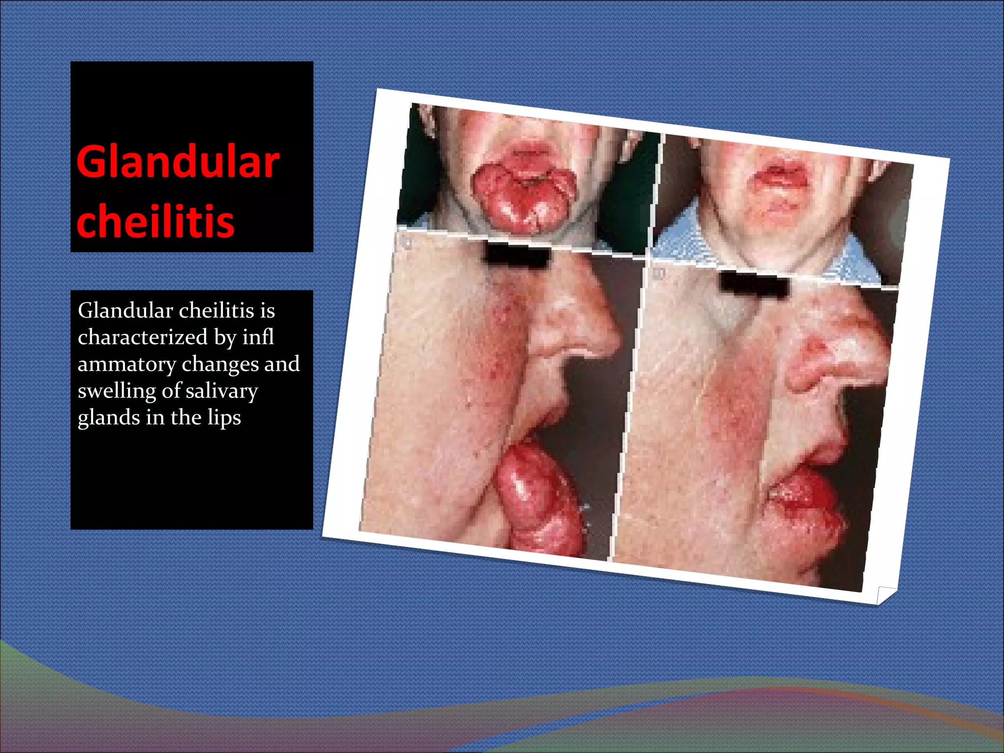 Cheilitis | PPT