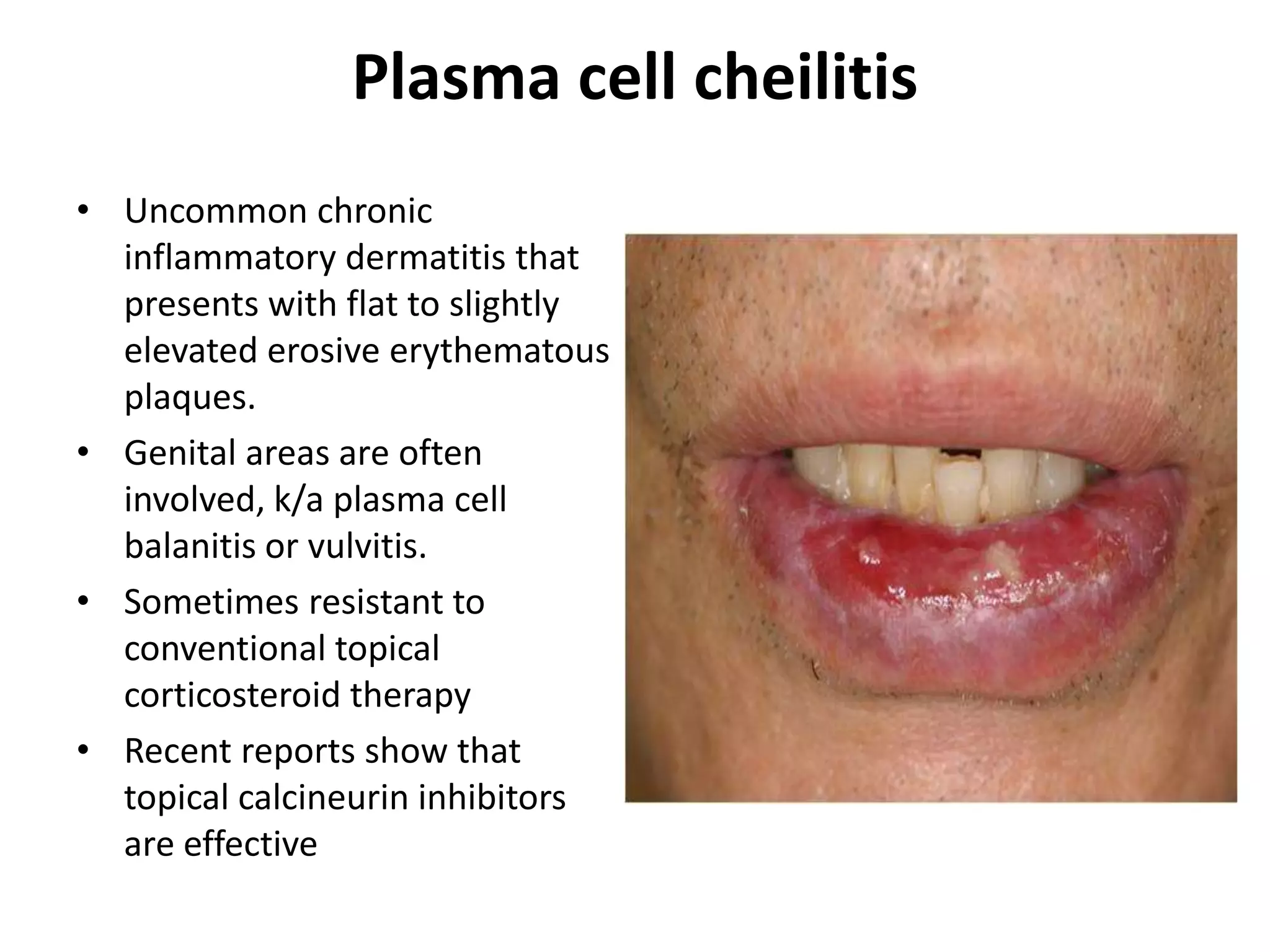 Cheilitis | PPTX