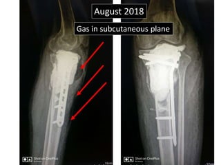 August 2018
Gas in subcutaneous plane
 