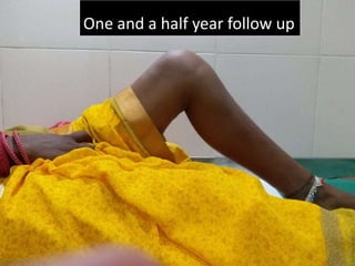 Dec 2019
One and a half year follow up
 