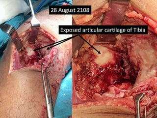 28 August 2108
Exposed articular cartilage of Tibia
 