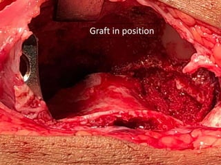 Graft in position
 