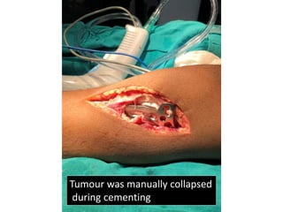 Tumour was manually collapsed
during cementing
 