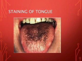 STAINING OF TONGUE
 