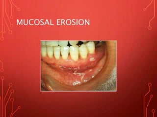 MUCOSAL EROSION
 