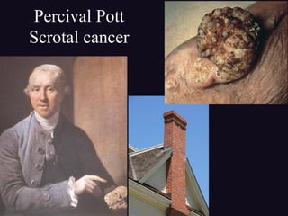 Percival Pott
Scrotal cancer
 