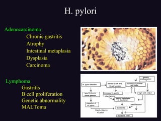 H. pylori
Adenocarcinoma
Chronic gastritis
Atrophy
Intestinal metaplasia
Dysplasia
Carcinoma
Lymphoma
Gastritis
B cell proliferation
Genetic abnormality
MALToma
 