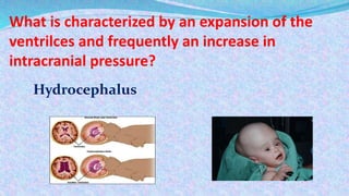 What is characterized by an expansion of the
ventrilces and frequently an increase in
intracranial pressure?
Hydrocephalus
 