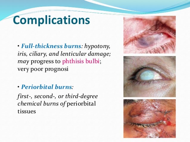 Chemical eye trauma, By Dr. Safaa Refaat