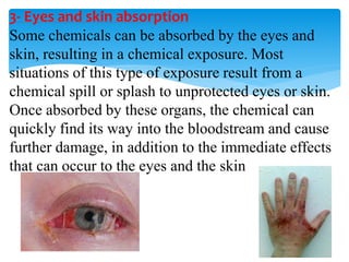 3- Eyes and skin absorption
Some chemicals can be absorbed by the eyes and
skin, resulting in a chemical exposure. Most
situations of this type of exposure result from a
chemical spill or splash to unprotected eyes or skin.
Once absorbed by these organs, the chemical can
quickly find its way into the bloodstream and cause
further damage, in addition to the immediate effects
that can occur to the eyes and the skin
 