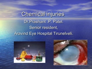 Chemical injuriesChemical injuries
Dr.Prashant .P. Patel.Dr.Prashant .P. Patel.
Senior resident,Senior resident,
Aravind Eye Hospital Tirunelveli.Aravind Eye Hospital Tirunelveli.
 