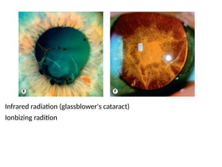 Infrared radiation (glassblower's cataract)
Ionbizing radition
 