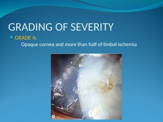 Chemical Injuries optometry slides(1).ppt