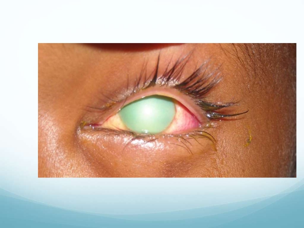 Chemical injuries of the eye