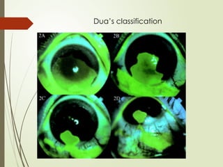 Dua’s classification
 