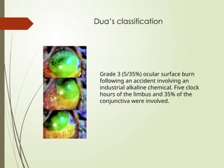 Dua’s classification
Grade 3 (5/35%) ocular surface burn
following an accident involving an
industrial alkaline chemical. Five clock
hours of the limbus and 35% of the
conjunctiva were involved.
 