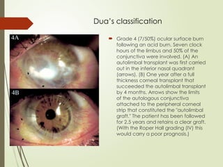 Dua’s classification
 Grade 4 (7/50%) ocular surface burn
following an acid burn. Seven clock
hours of the limbus and 50% of the
conjunctiva were involved. (A) An
autolimbal transplant was first carried
out in the inferior nasal quadrant
(arrows). (B) One year after a full
thickness corneal transplant that
succeeded the autolimbal transplant
by 4 months. Arrows show the limits
of the autologous conjunctiva
attached to the peripheral corneal
strip that constituted the "autolimbal
graft." The patient has been followed
for 2.5 years and retains a clear graft.
(With the Roper Hall grading (IV) this
would carry a poor prognosis.)
 