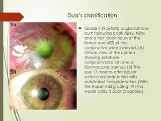 Dua’s classification
 Grade 5 (9.5/60%) ocular surface
burn following alkali injury. Nine
and a half clock hours of the
limbus and 60% of the
conjunctiva were involved. (A)
Diffuse view of the cornea
showing extensive
conjunctivalisation and a
fibrovascular pannus. (B) The
eye 13 months after ocular
surface reconstruction with
autolimbal transplantation. (With
the Roper Hall grading (IV) this
would carry a poor prognosis.)
 