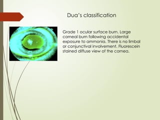 Dua’s classification
Grade 1 ocular surface burn. Large
corneal burn following accidental
exposure to ammonia. There is no limbal
or conjunctival involvement. Fluorescein
stained diffuse view of the cornea.
 