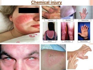 Chemical Injury.pptx
