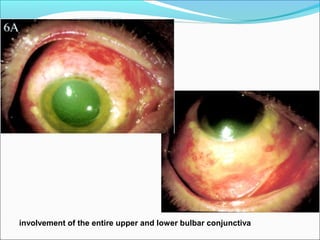 involvement of the entire upper and lower bulbar conjunctiva
 