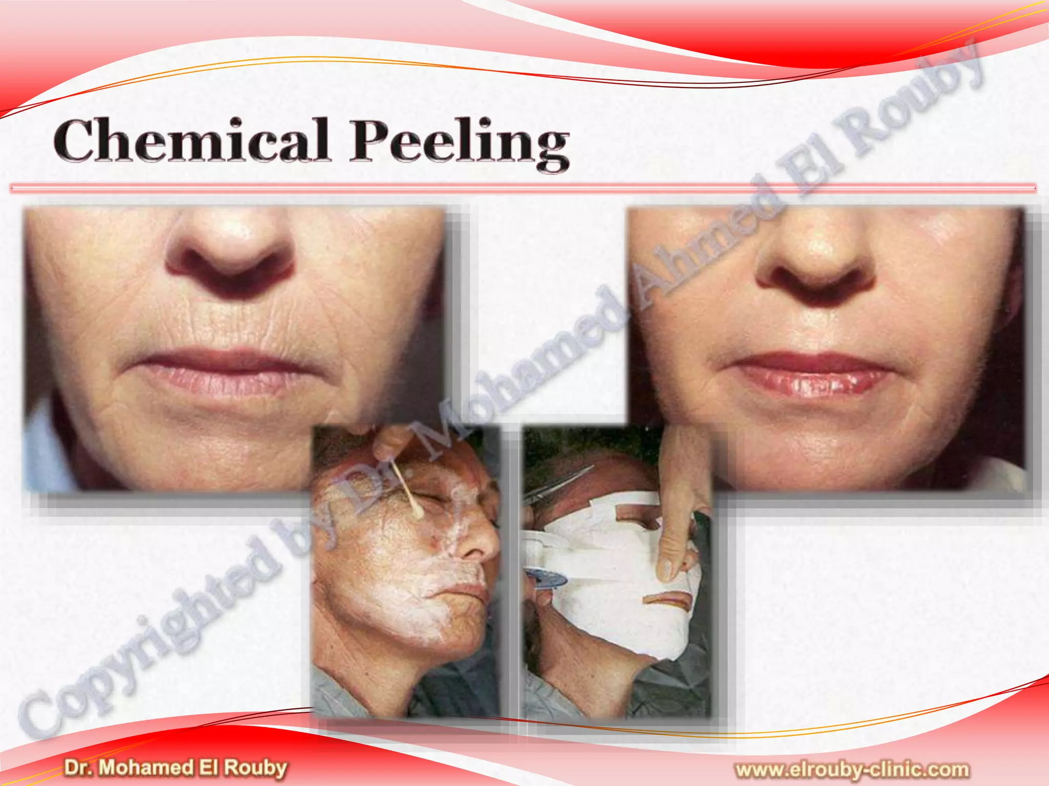 Chemical peel